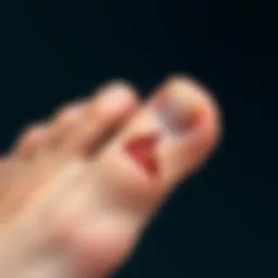 Illustration of a broken toenail showing the fracture and injury site